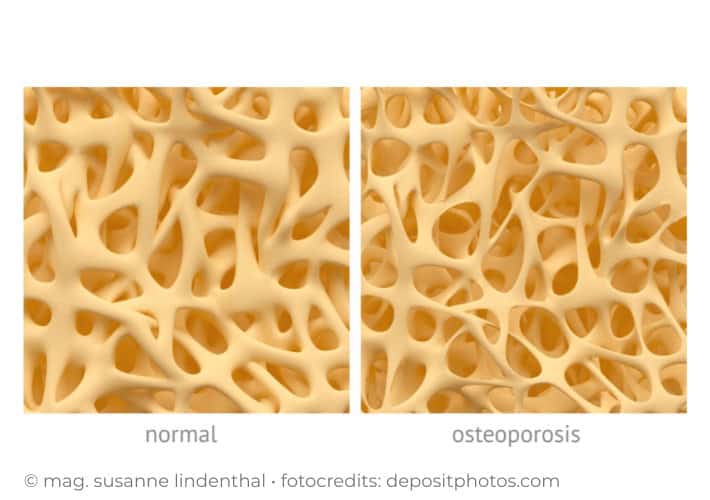 Knochengesundheit und Osteoporose in den Wechseljahren-Knochenstruktur gesund versus Osteoporose